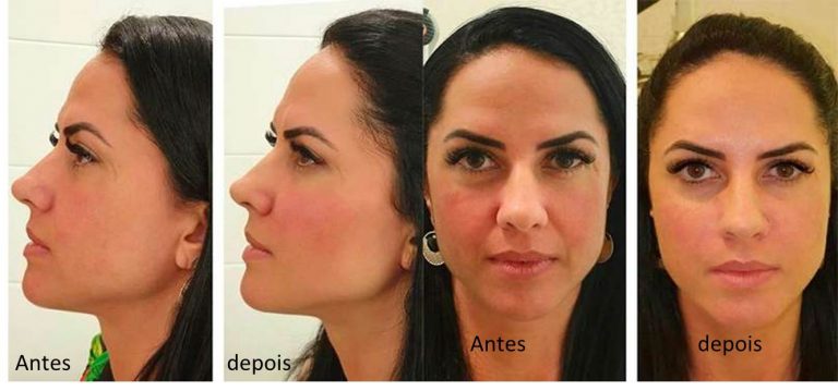 Harmoniza\u00e7\u00e3o facial \u2013 O que precisa saber? - Integra Not\u00edcias - Sua ...